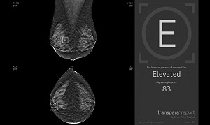 Die KI-basierte Software wertet die Bildaufnahme der Brust automatisch aus und ordnet sie einer von drei Risikokategorien zu.  Screenshot: Transpara