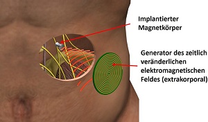 Prinzipskizze des »Magnetoceuticals«-Ansatzes: Lediglich ein magnetischer Implantatkörper wird in den menschlichen Körper implantiert. Die gesamte Intelligenz des elektronischen Systems sitzt in einer extrakorporalen, miniaturisierten Elektronik.  Fraunhofer IBMT.