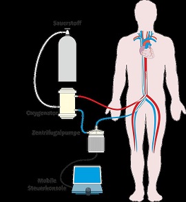 Schematische Darstellung Mobile Herz-Lungen-Maschine  Quelle: Prof. Dr.-Ing. Christoph Benk