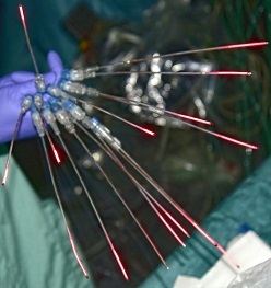Beim „Tookad“-Verfahren werden Laserfasern zur Aktvierung des fotosensitiven Wirkstoffs Padeliporfin genutzt.  Foto: Uniklinikum Dresden / Thomas Albrecht