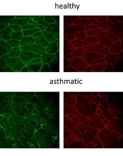 Gerade und klare Epithelbarriere von gesunden Bronchialepithelzellen (oben) und undichte und beschädigte asthmatische Epithelzellen (unten).  (Bild: Cezmi Akdis)