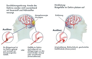 Ursachen des Schlaganfalls: Die meisten Schlaganfälle werden von einer Durchblutungsstörung im Gehirn verursacht. Copyright: DHS/Jan Neuffer