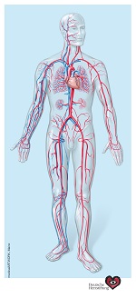 Fortgeschrittene Arteriosklerose mit starken Ablagerungen und folgender Einengung