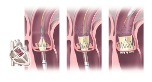 TAVI: Freisetzung einer Aortenklappenprothese.  Illustration: medicalARTWORK, Mainz