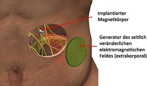 Prinzipskizze des »Magnetoceuticals«-Ansatzes: Lediglich ein magnetischer Implantatkörper wird in den menschlichen Körper implantiert. Die gesamte Intelligenz des elektronischen Systems sitzt in einer extrakorporalen, miniaturisierten Elektronik.  Fraunhofer IBMT.
